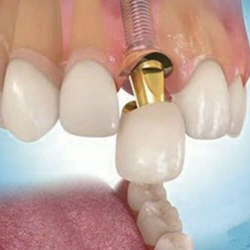 ¿Qué se puede comer después de un implante dental?